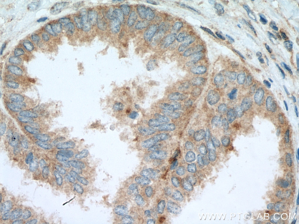 IHC staining of human ovary tumor using 11127-2-AP