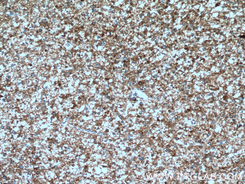 Immunohistochemistry (IHC) staining of human gliomas tissue using Endophilin 1 Polyclonal antibody (12435-1-AP)