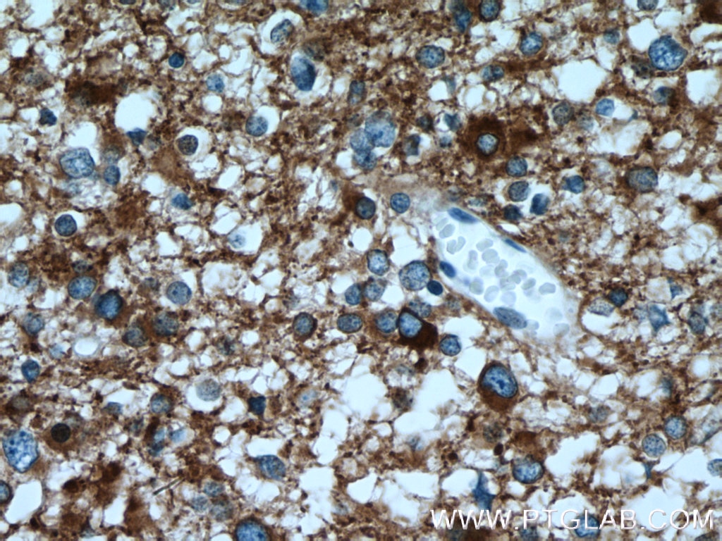 Immunohistochemistry (IHC) staining of human gliomas tissue using Endophilin 1 Polyclonal antibody (12435-1-AP)