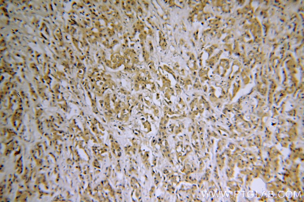 Immunohistochemistry (IHC) staining of human breast cancer tissue using SH3PXD2A Polyclonal antibody (18976-1-AP)