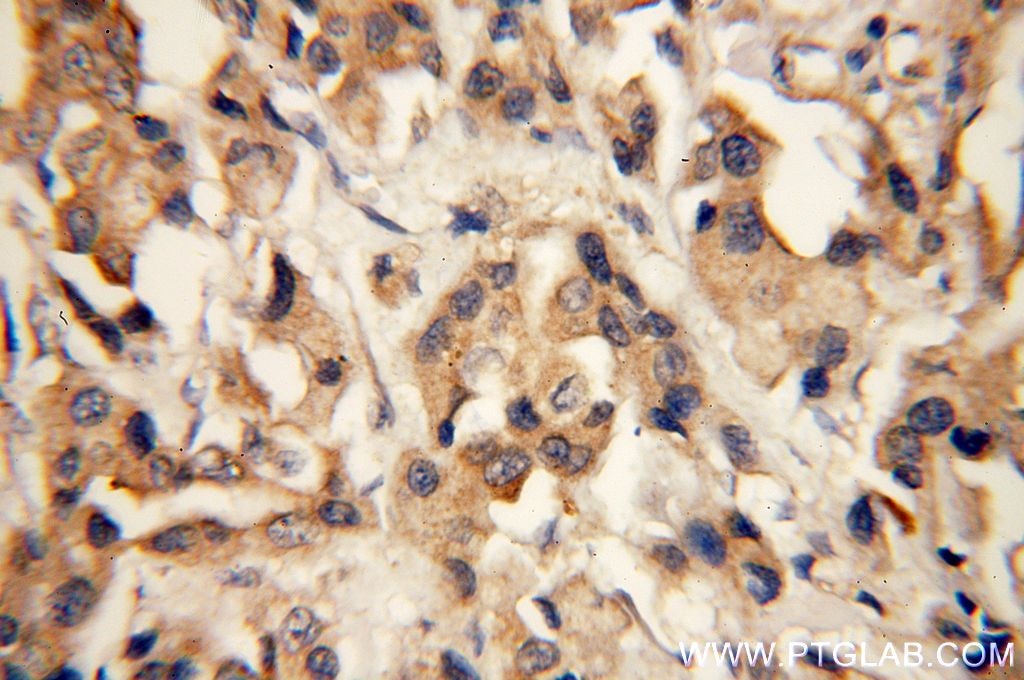 Immunohistochemistry (IHC) staining of human breast cancer tissue using SH3PXD2A Polyclonal antibody (18976-1-AP)