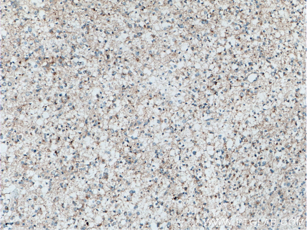 Immunohistochemistry (IHC) staining of human gliomas tissue using POSH Polyclonal antibody (14649-1-AP)