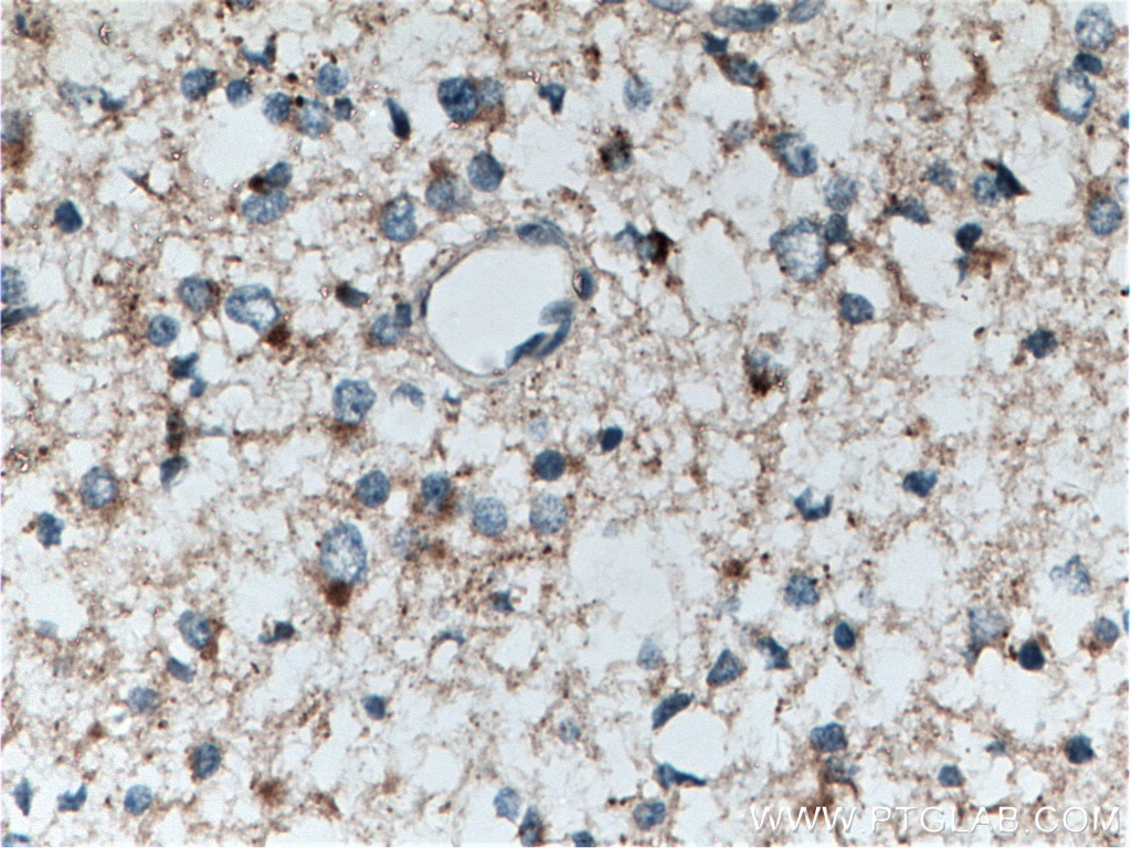 Immunohistochemistry (IHC) staining of human gliomas tissue using POSH Polyclonal antibody (14649-1-AP)