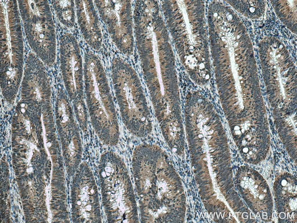 Immunohistochemistry (IHC) staining of human colon cancer tissue using SH3RF2 Polyclonal antibody (13306-1-AP)