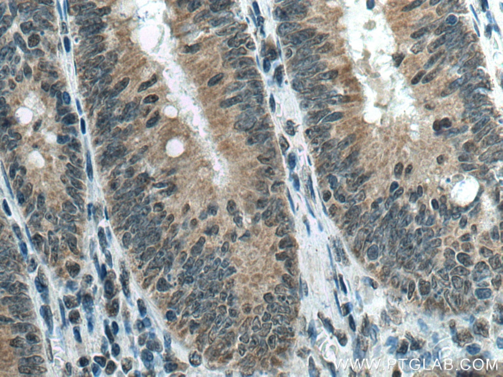 Immunohistochemistry (IHC) staining of human colon cancer tissue using SH3RF2 Polyclonal antibody (13306-1-AP)