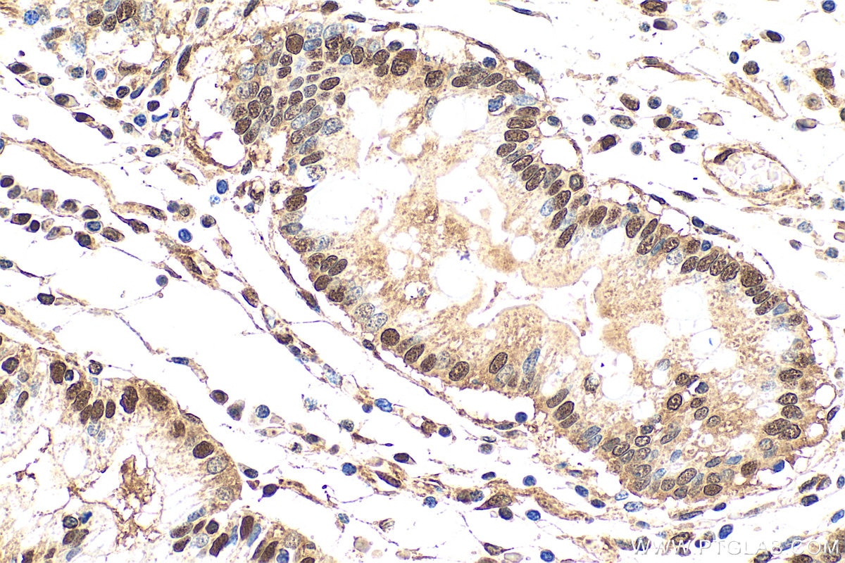 IHC staining of human stomach cancer using 27905-1-AP Immunohistochemistry (IHC) staining of human stomach cancer tissue using SH3TC2 Polyclonal antibody (27905-1-AP)