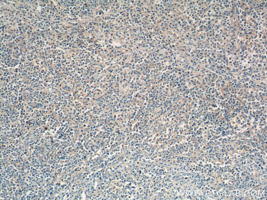 Immunohistochemistry (IHC) staining of human lymphoma tissue using SHARPIN Polyclonal antibody (14626-1-AP)