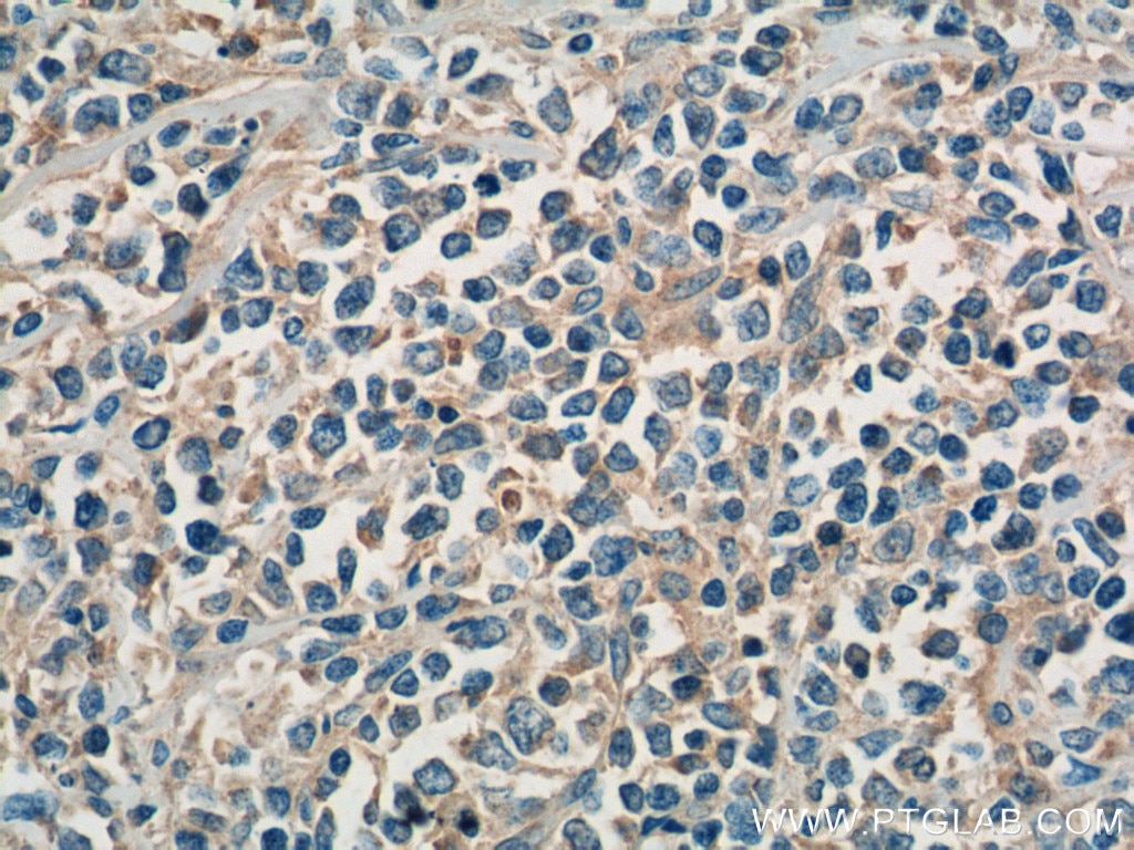 Immunohistochemistry (IHC) staining of human lymphoma tissue using SHARPIN Polyclonal antibody (14626-1-AP)