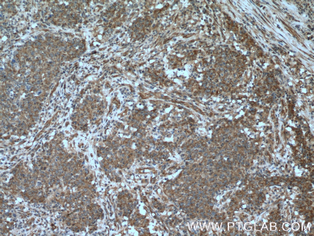 Immunohistochemistry (IHC) staining of human colon cancer tissue using SHC Polyclonal antibody (10054-1-AP)