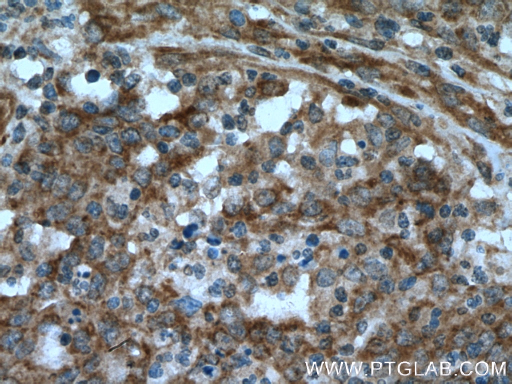 Immunohistochemistry (IHC) staining of human colon cancer tissue using SHC Polyclonal antibody (10054-1-AP)