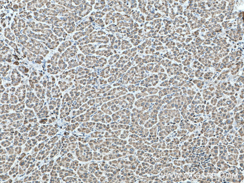 Immunohistochemistry (IHC) staining of human liver cancer tissue using SHCBP1 Polyclonal antibody (12672-1-AP)