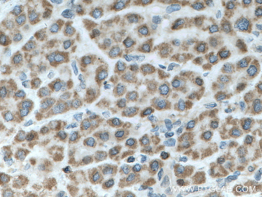 Immunohistochemistry (IHC) staining of human liver cancer tissue using SHCBP1 Polyclonal antibody (12672-1-AP)