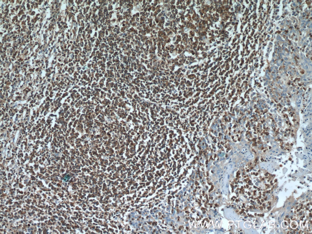 Immunohistochemistry (IHC) staining of human tonsillitis tissue using SHCBP1 Polyclonal antibody (12672-1-AP)