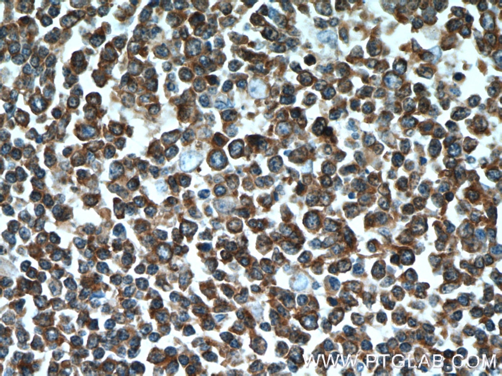 Immunohistochemistry (IHC) staining of human tonsillitis tissue using SHCBP1 Polyclonal antibody (12672-1-AP)