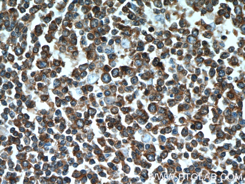 IHC staining of human tonsillitis using 12672-1-AP