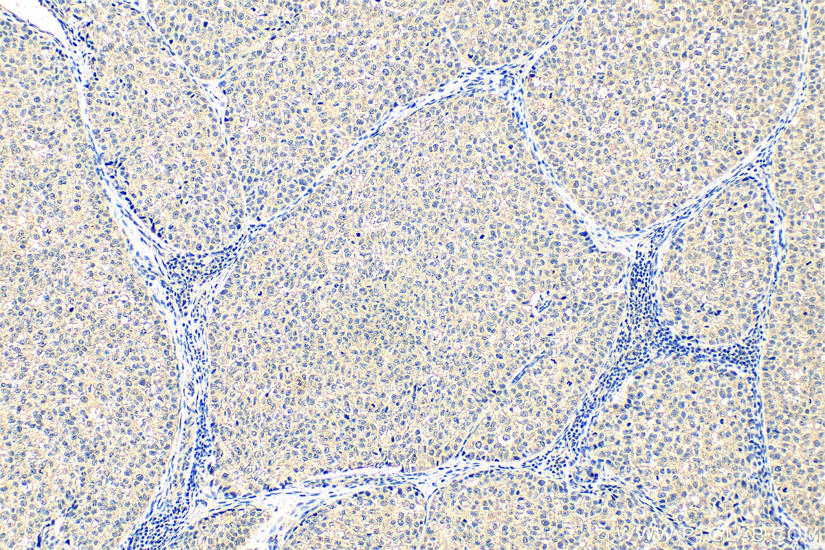 IHC staining of human breast cancer using 68647-1-Ig