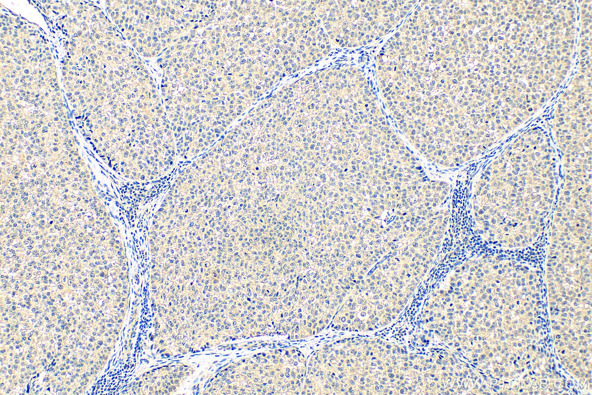 Immunohistochemistry (IHC) staining of human breast cancer tissue using SHCBP1 Monoclonal antibody (68647-1-Ig)