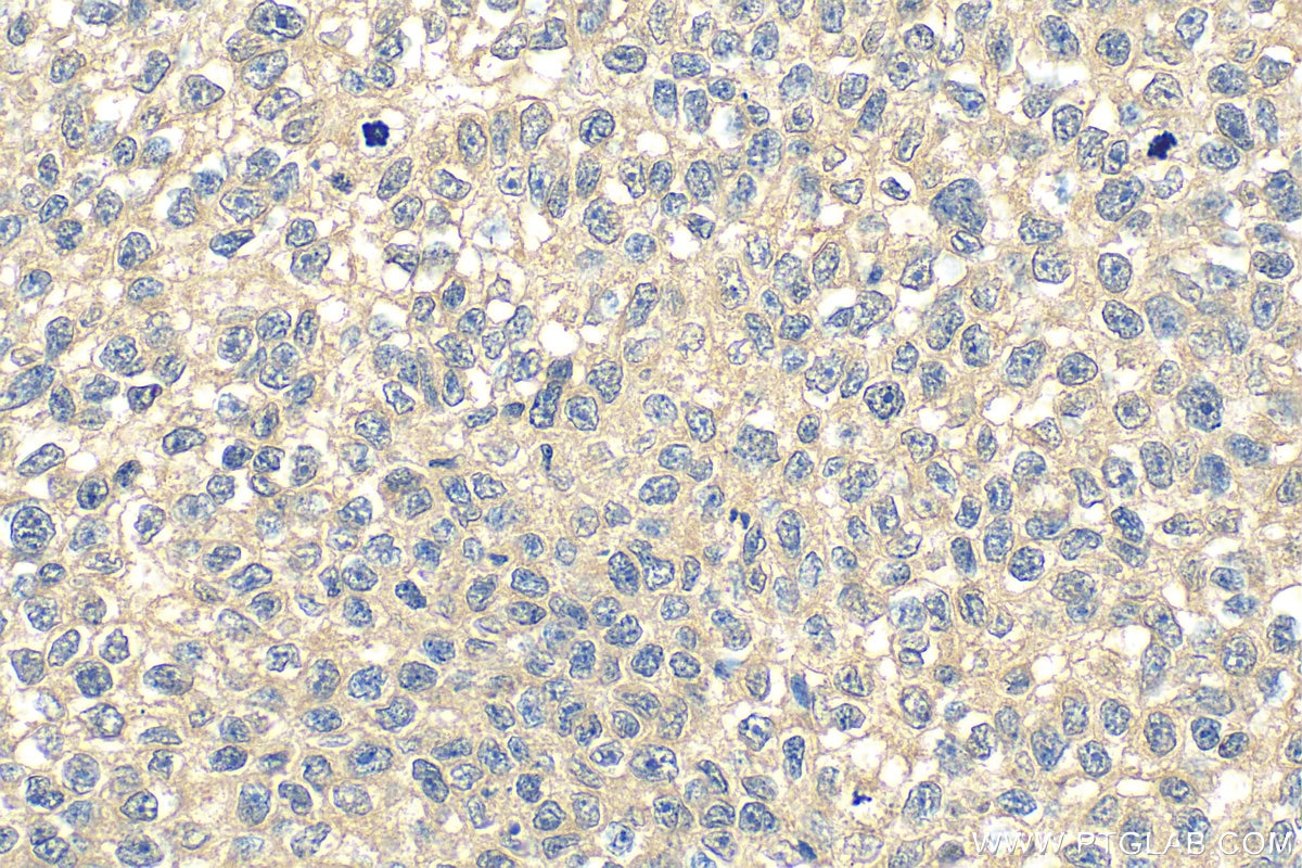 IHC staining of human breast cancer using 68647-1-Ig