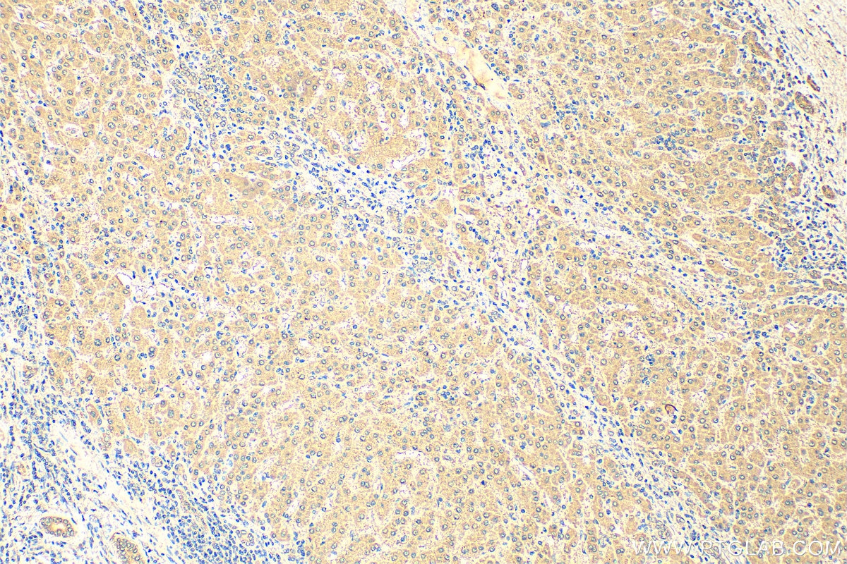 IHC staining of human liver cancer using 68647-1-Ig