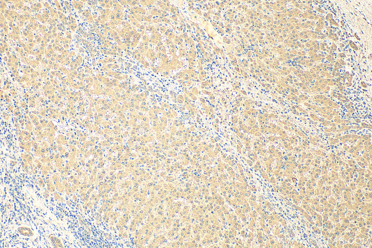 Immunohistochemistry (IHC) staining of human liver cancer tissue using SHCBP1 Monoclonal antibody (68647-1-Ig)