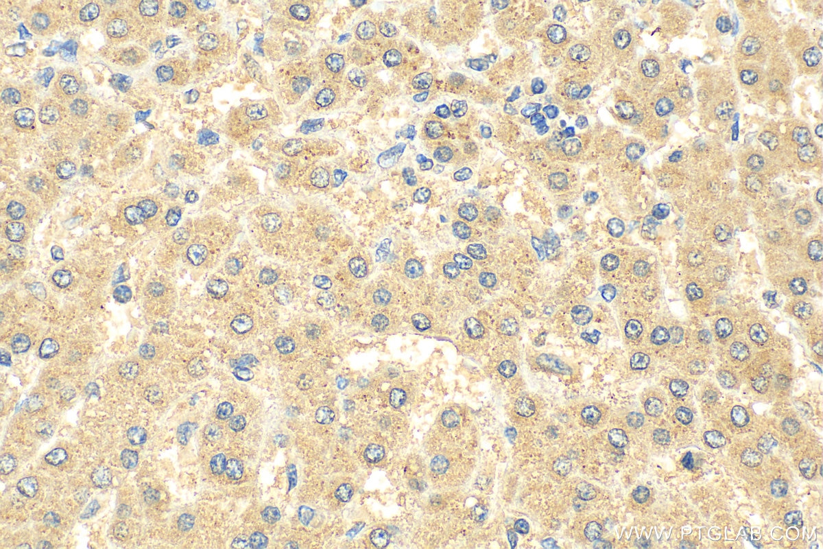 Immunohistochemistry (IHC) staining of human liver cancer tissue using SHCBP1 Monoclonal antibody (68647-1-Ig)