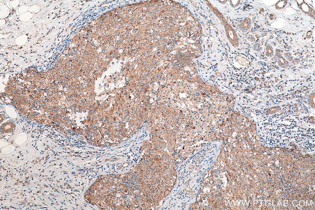 Immunohistochemistry (IHC) staining of human breast cancer tissue using SHE Polyclonal antibody (22902-1-AP)