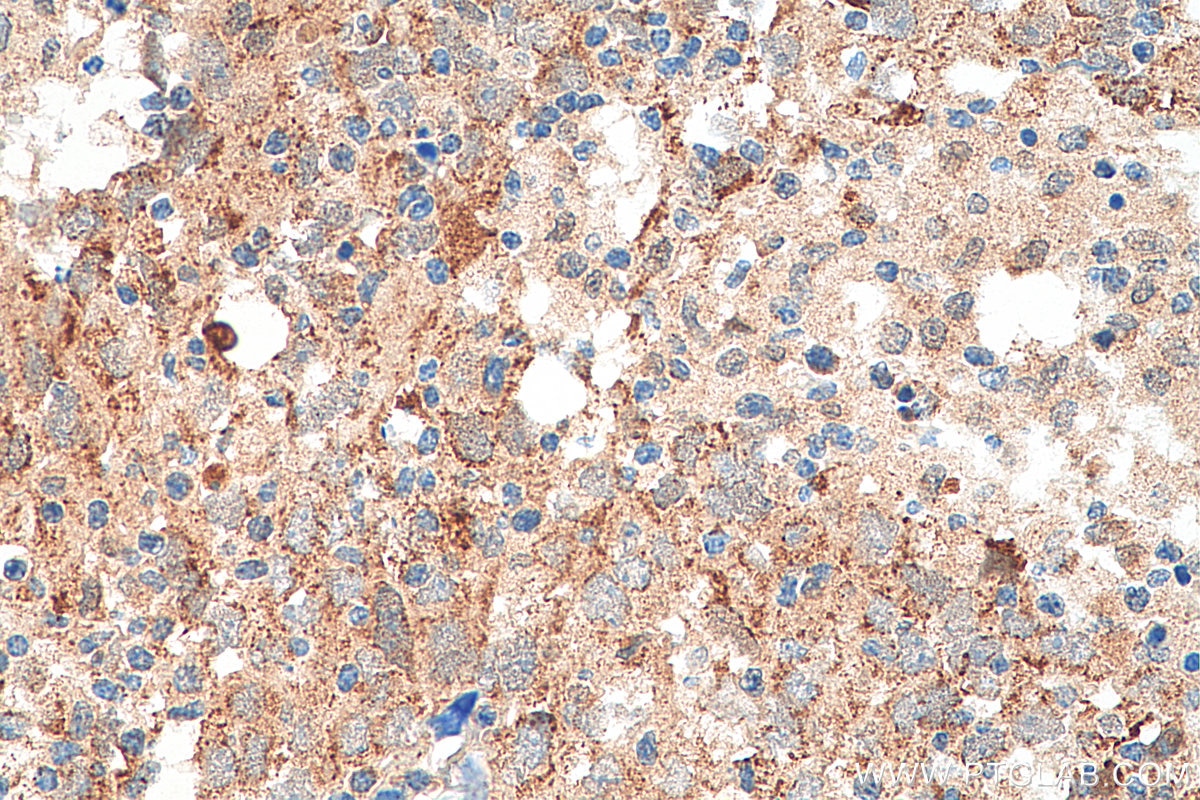 Immunohistochemistry (IHC) staining of human breast cancer tissue using SHE Polyclonal antibody (22902-1-AP)