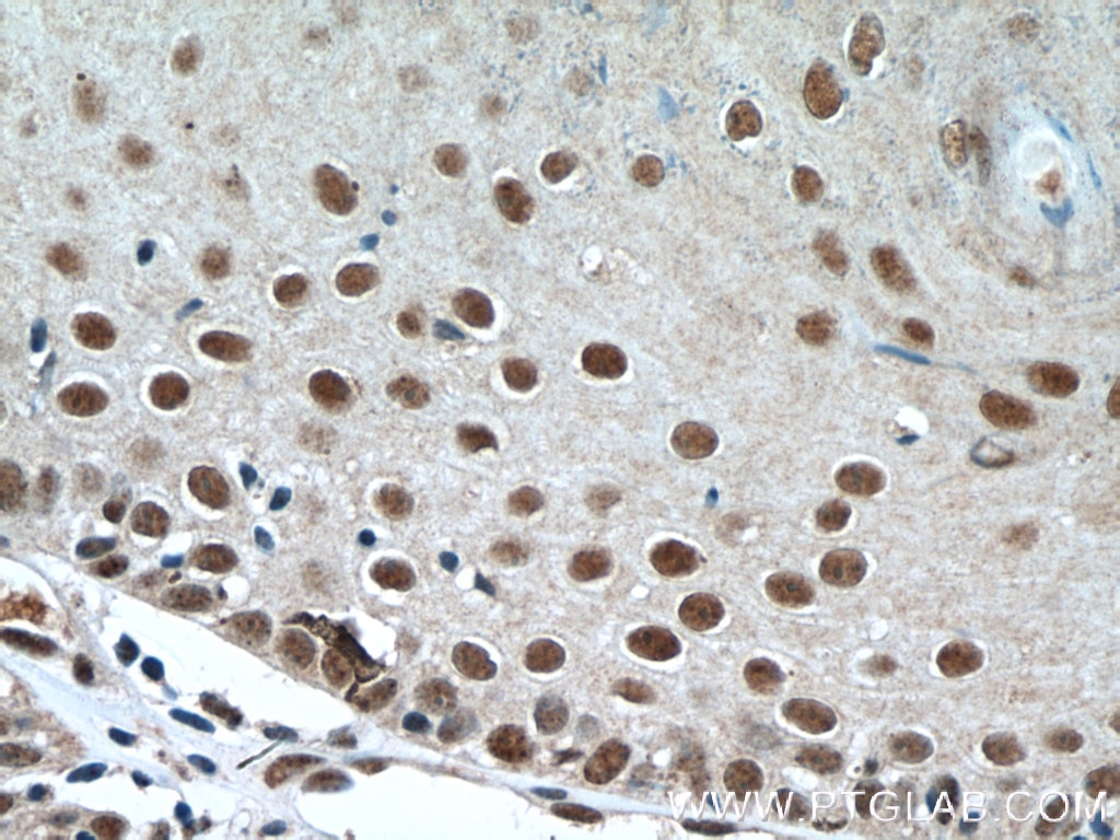 Immunohistochemistry (IHC) staining of human skin cancer tissue using DSS1 Polyclonal antibody (13639-1-AP)