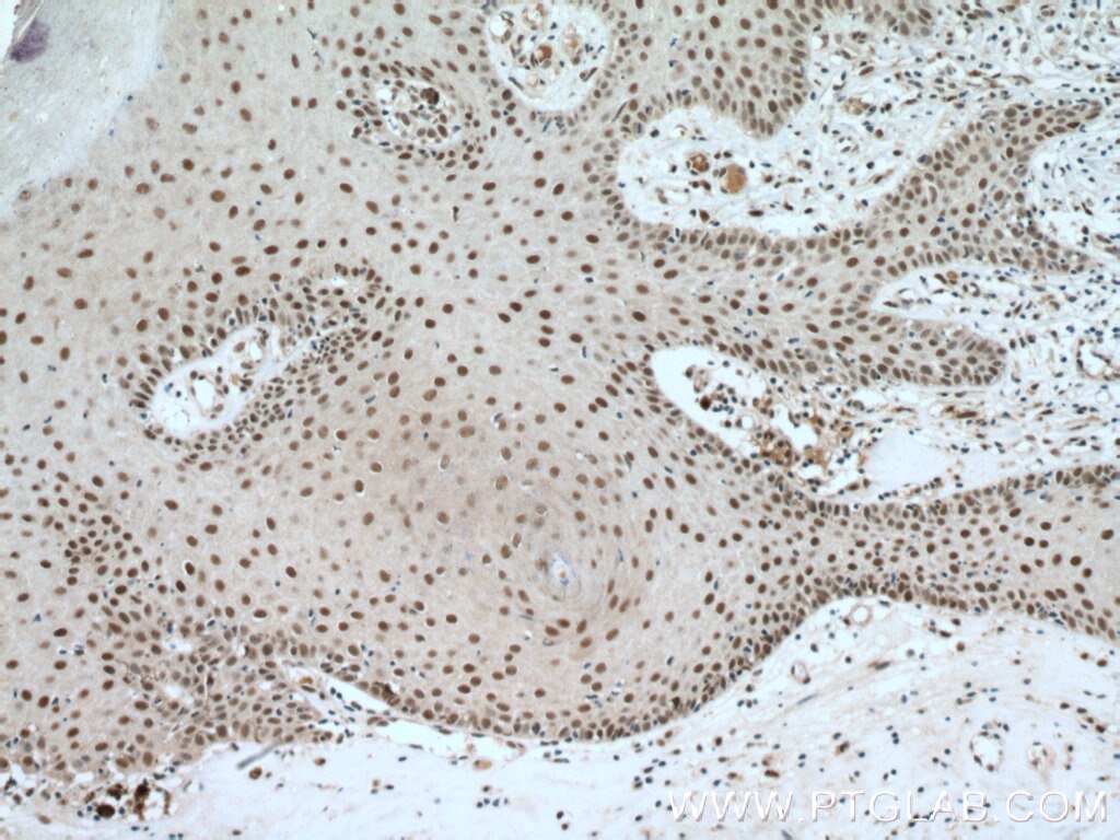 Immunohistochemistry (IHC) staining of human skin cancer tissue using DSS1 Polyclonal antibody (13639-1-AP)