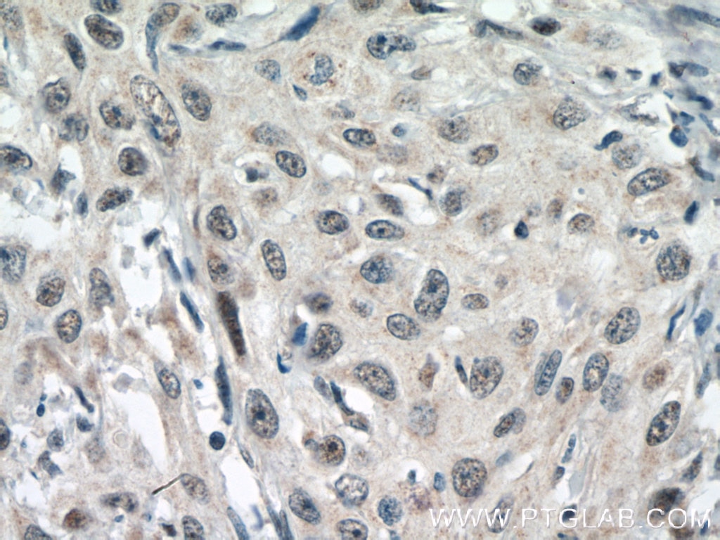 Immunohistochemistry (IHC) staining of human cervical cancer tissue using DSS1 Polyclonal antibody (13639-1-AP)