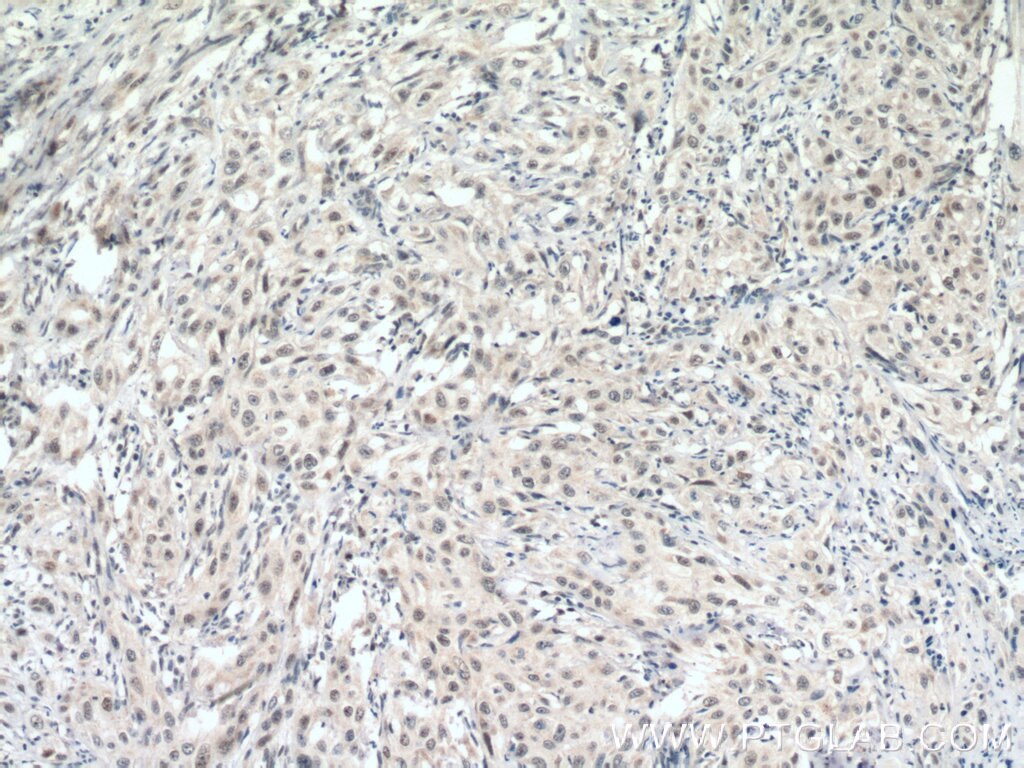 Immunohistochemistry (IHC) staining of human cervical cancer tissue using DSS1 Polyclonal antibody (13639-1-AP)