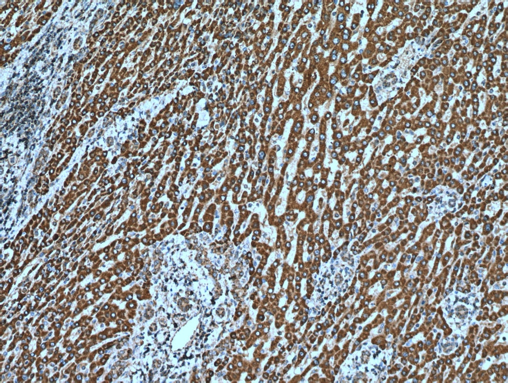 Immunohistochemistry (IHC) staining of human liver cancer tissue using SHH Polyclonal antibody (20697-1-AP)