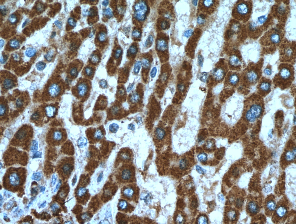 Immunohistochemistry (IHC) staining of human liver cancer tissue using SHH Polyclonal antibody (20697-1-AP)