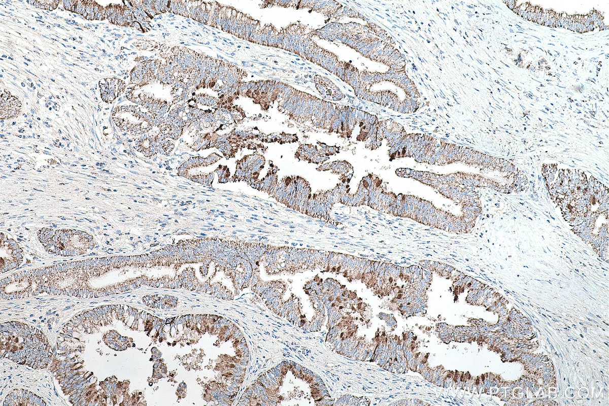 Immunohistochemistry (IHC) staining of human pancreas cancer tissue using SHH Polyclonal antibody (20697-1-AP)