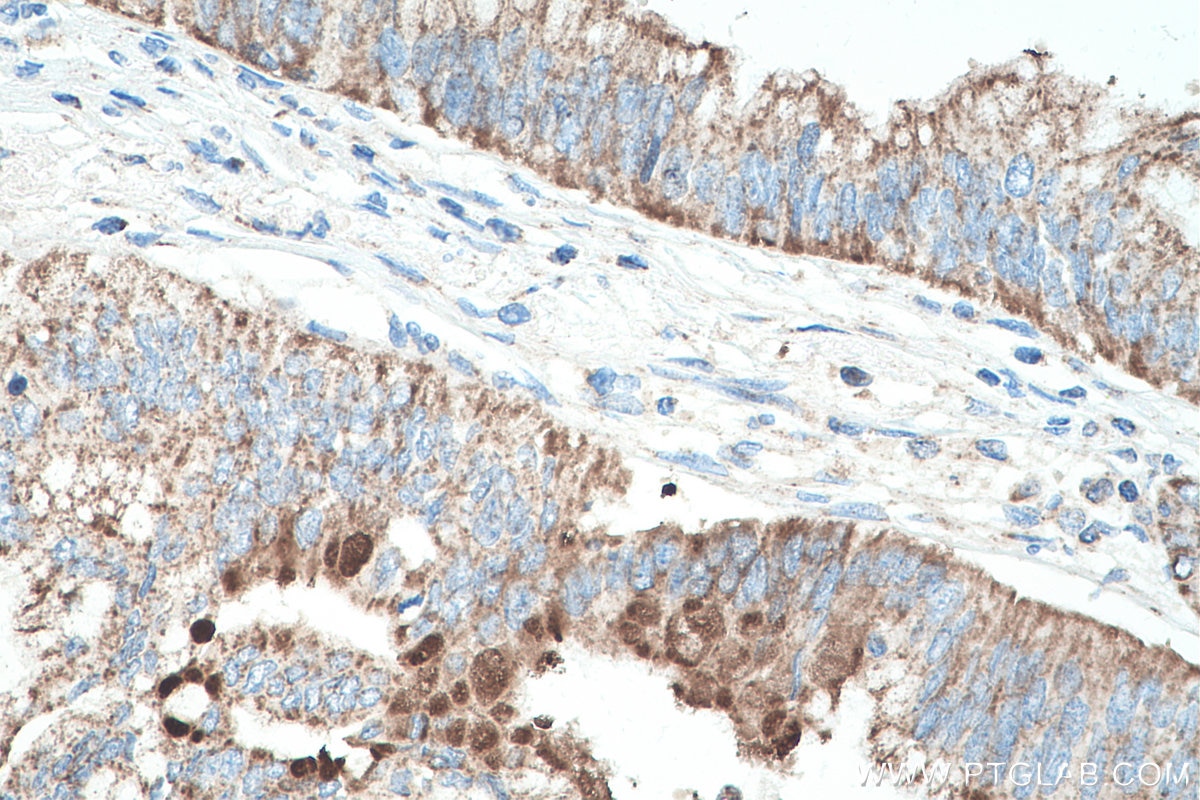 Immunohistochemistry (IHC) staining of human pancreas cancer tissue using SHH Polyclonal antibody (20697-1-AP)