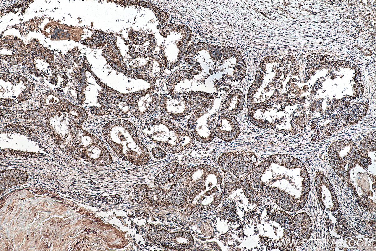 Immunohistochemistry (IHC) staining of human ovary tumor tissue using SHH Polyclonal antibody (20697-1-AP)