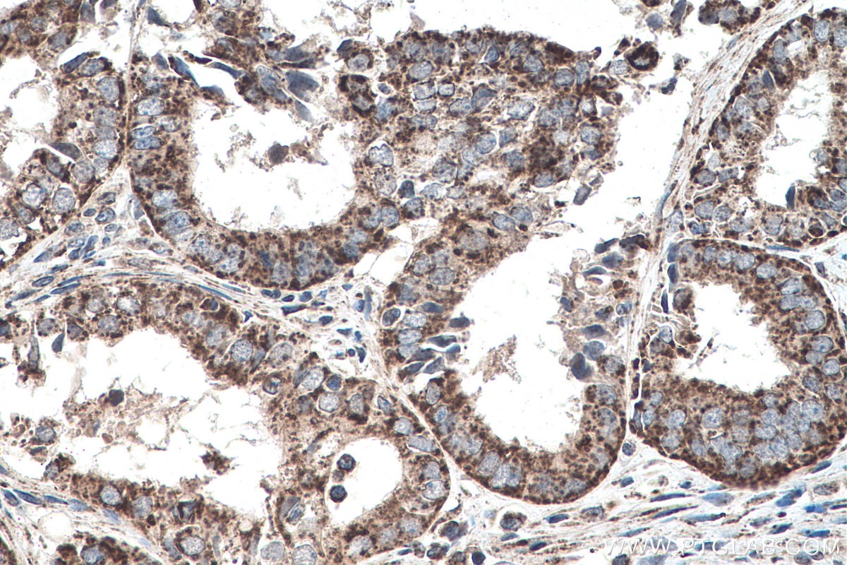 Immunohistochemistry (IHC) staining of human ovary tumor tissue using SHH Polyclonal antibody (20697-1-AP)