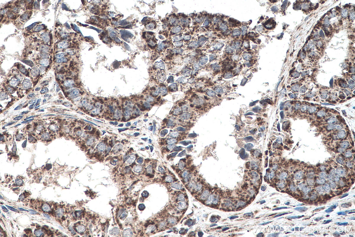 IHC staining of human ovary tumor using 20697-1-AP