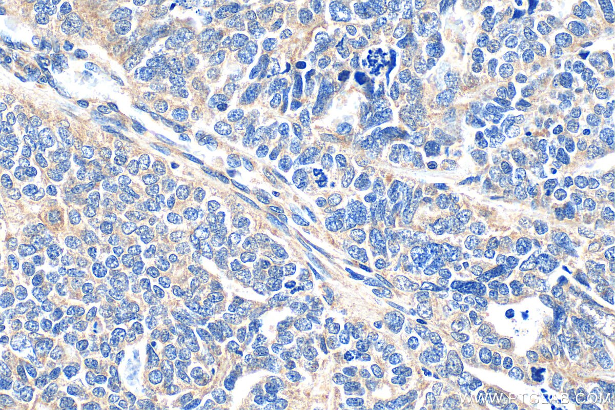 IHC staining of human ovary tumor using 24347-1-AP Immunohistochemistry (IHC) staining of human ovary tumor tissue using SHLD1 Polyclonal antibody (24347-1-AP)