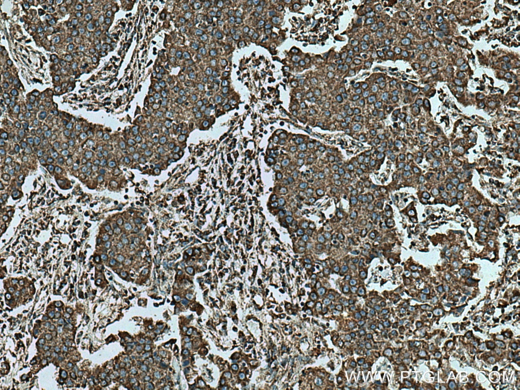 Immunohistochemistry (IHC) staining of human breast cancer tissue using SHMT1 Polyclonal antibody (14149-1-AP)
