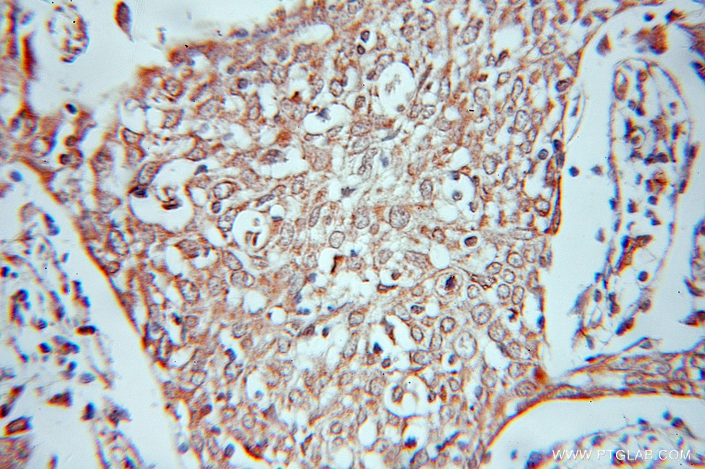 Immunohistochemistry (IHC) staining of human cervical cancer tissue using SHMT2 Polyclonal antibody (11099-1-AP)