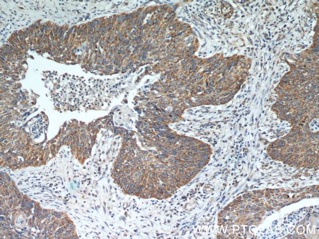 Immunohistochemistry (IHC) staining of human cervical cancer tissue using SHMT2 Polyclonal antibody (11099-1-AP)