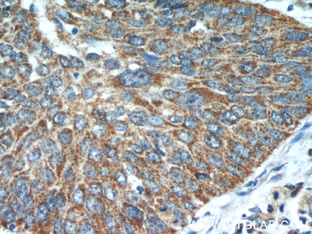 IHC staining of human cervical cancer using 11099-1-AP