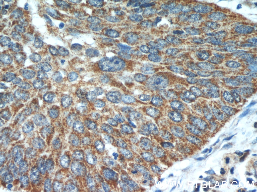 Immunohistochemistry (IHC) staining of human cervical cancer tissue using SHMT2 Polyclonal antibody (11099-1-AP)