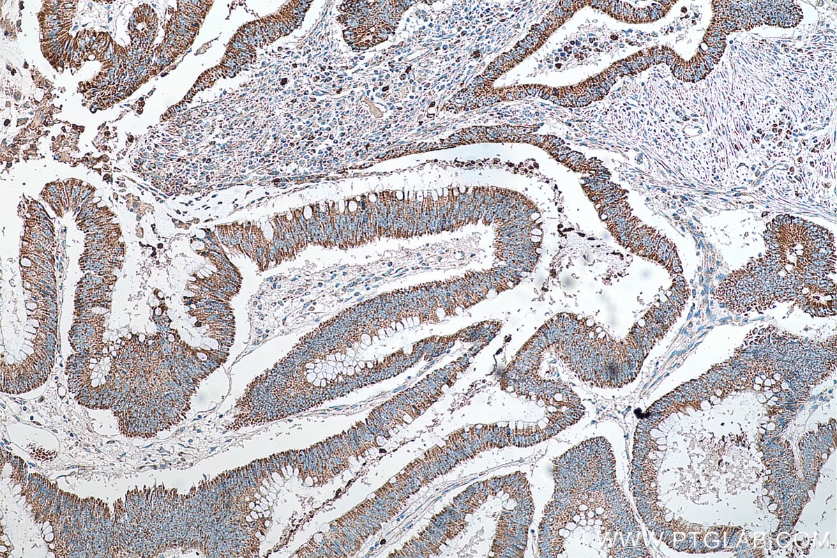 Immunohistochemistry (IHC) staining of human colon cancer tissue using SHMT2 Monoclonal antibody (67980-1-Ig)
