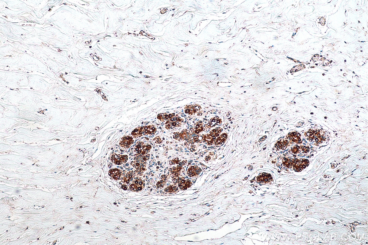 Immunohistochemistry (IHC) staining of human breast cancer tissue using SHMT2 Monoclonal antibody (67980-1-Ig)