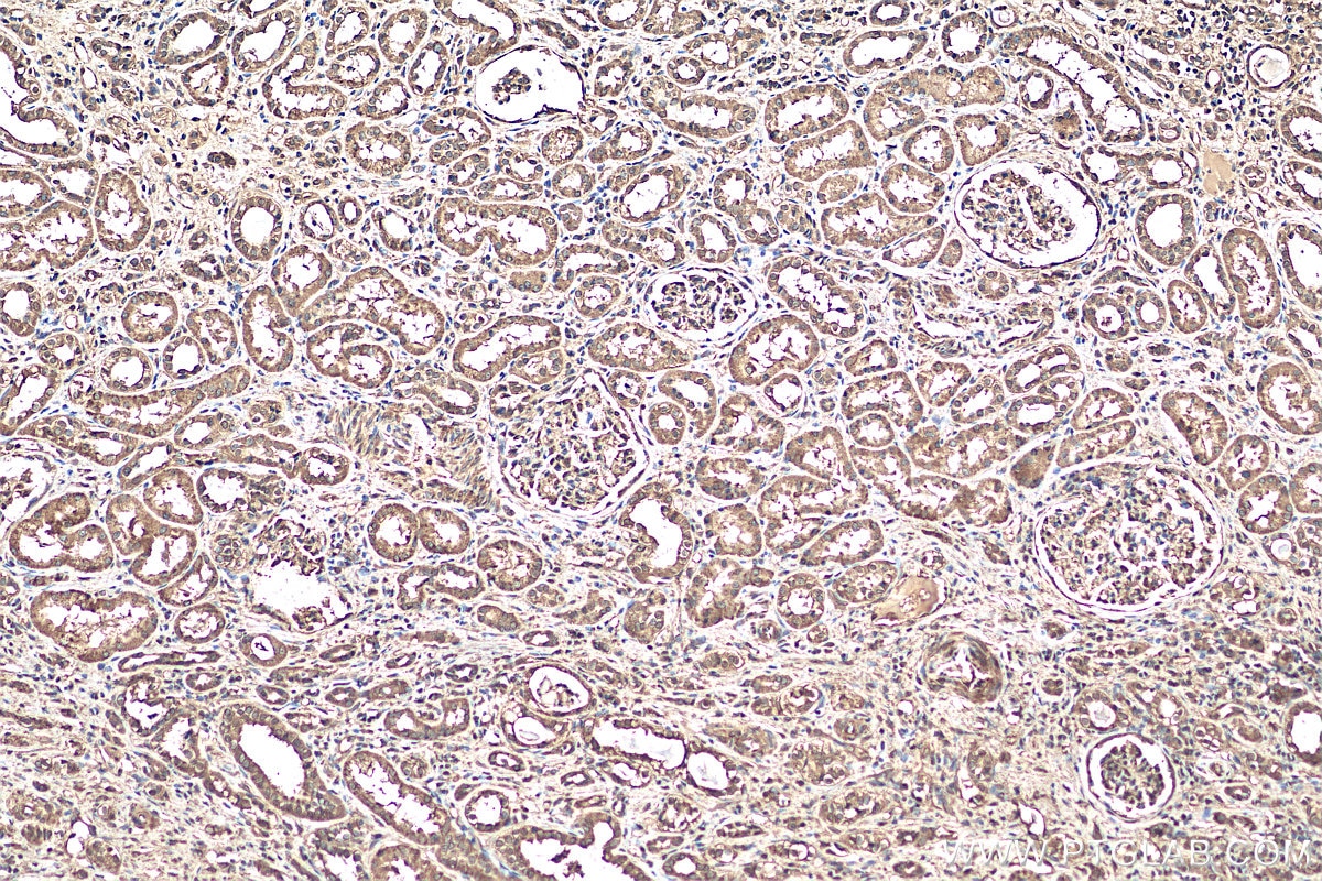 Immunohistochemistry (IHC) staining of human renal cell carcinoma tissue using Sur-8 Polyclonal antibody (17561-1-AP)