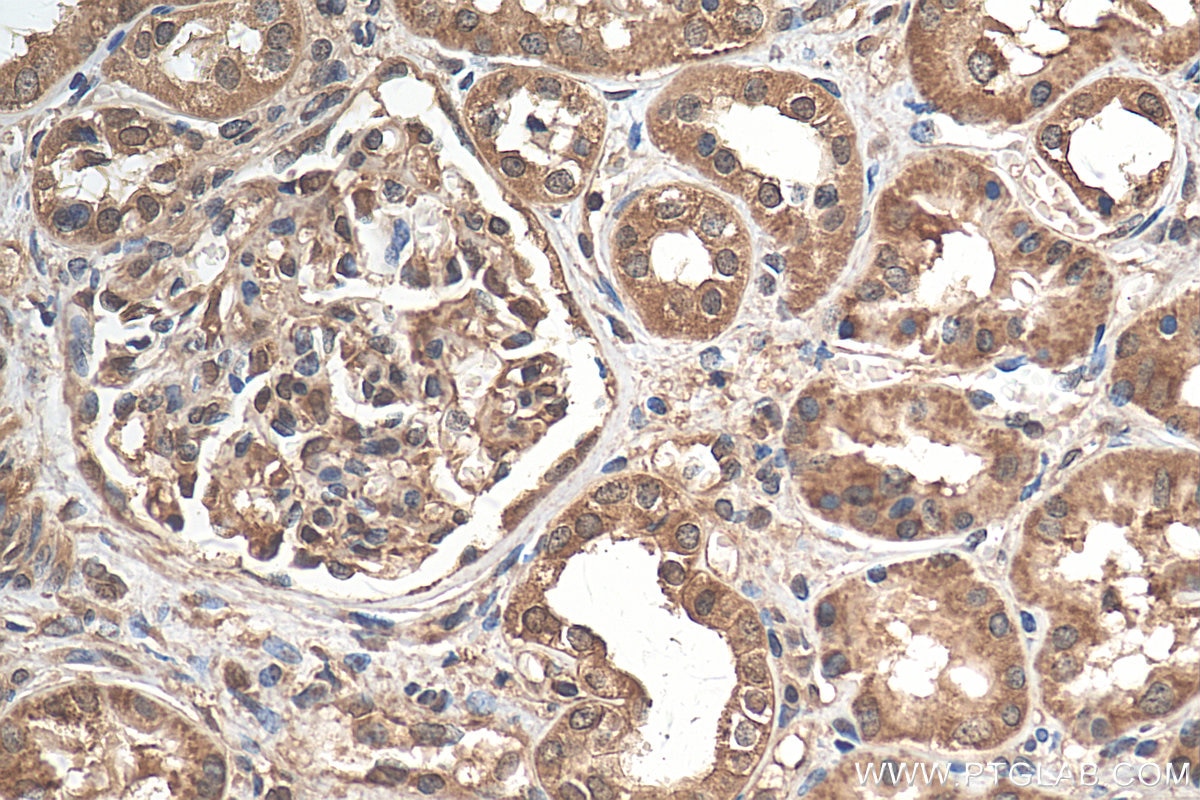 Immunohistochemistry (IHC) staining of human renal cell carcinoma tissue using Sur-8 Polyclonal antibody (17561-1-AP)