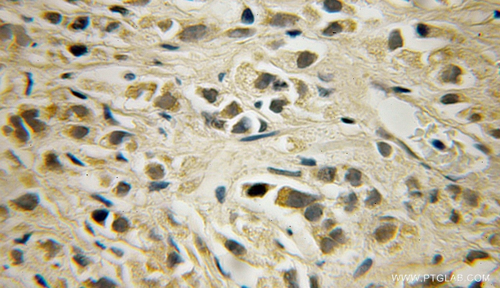 Immunohistochemistry (IHC) staining of human prostate cancer tissue using SHPK Polyclonal antibody (12441-1-AP)