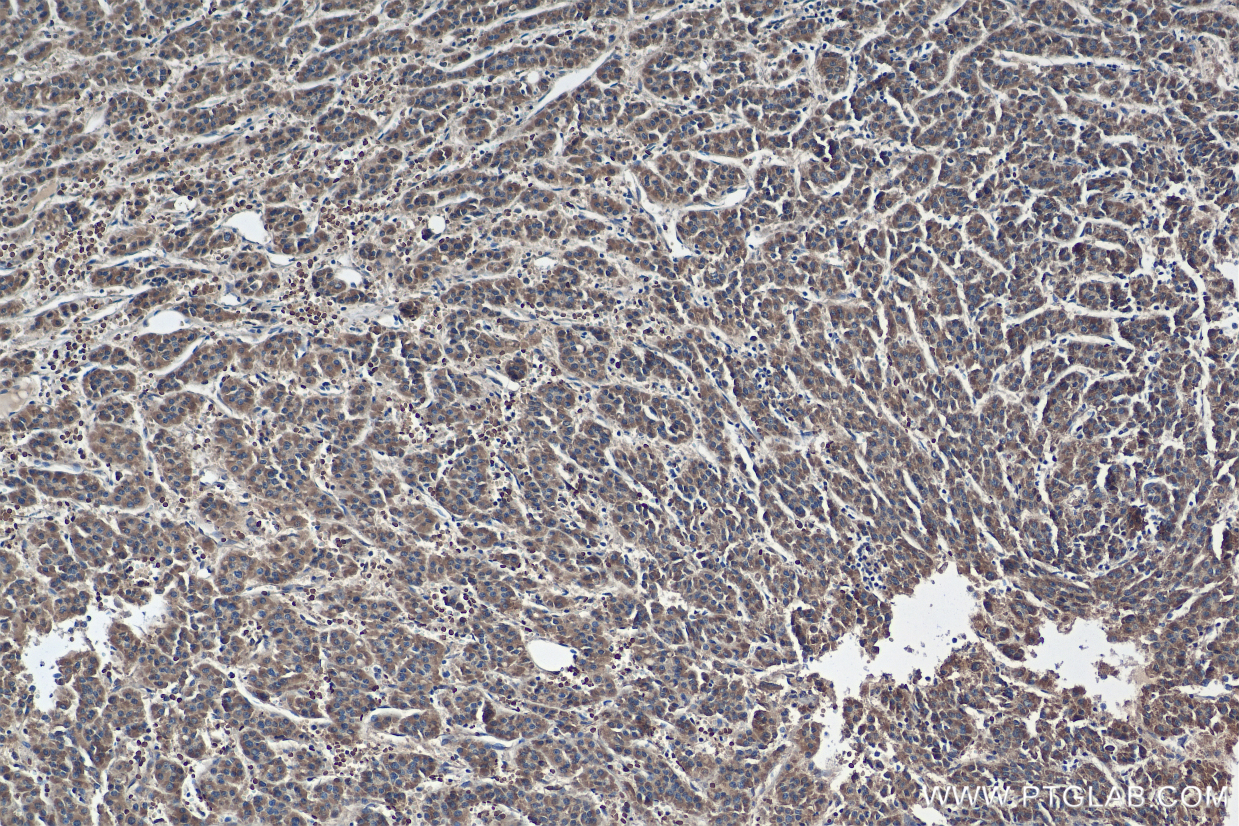 Immunohistochemistry (IHC) staining of Human Hepatocellular cancer using SHPK Recombinant antibody (82875-1-RR)
